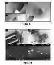 Fig. 07 - Method and device for statistical tissue sampling using microdevices
