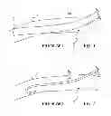 Fig. 02 - Minimally-advancing luminal catheter