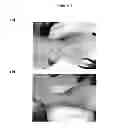 Fig. 02 - Use of local anesthesia and electrical stimulation in peripheral wound treatment