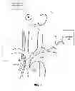Fig. 02 - Venous modulation of collateral perfusion of cerebral ischemia