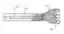 Fig. 01 - Dynamic microvalve protection device with associated balloon element for therapeutic intravascular procedures