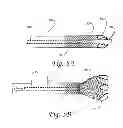 Fig. 06 - Dynamic microvalve protection device with associated balloon element for therapeutic intravascular procedures