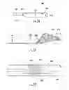 Fig. 22 - Dynamic microvalve protection device with associated balloon element for therapeutic intravascular procedures