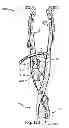 Fig. 35 - Spinous Process Fusion Implants and Insertion, Compression, and Locking Instrumentation