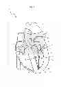 Fig. 02 - Implant delivery and deployment system and method