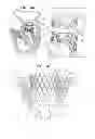 Fig. 07 - Anchoring of prosthetic valve supports