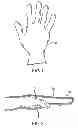 Fig. 02 - Surgical glove with ergonomic features