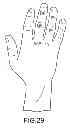 Fig. 20 - Surgical glove with ergonomic features