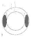 Fig. 04 - Contact lens having peripheral high modulus zones