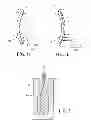 Fig. 02 - Method for determining front and rear surfaces for optical patches