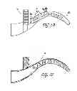 Fig. 04 - Intraoral device