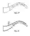 Fig. 07 - Intraoral device