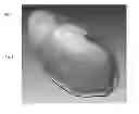 Fig. 02 - Pregnant abdominal system and associated devices, systems, and methods