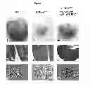 Fig. 02 - METHODS AND PHARMACEUTICAL COMPOSITIONS FOR TREATING LYMPHOID MALIGNANCY