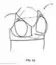 Fig. 43 - Apparatus and method for electromagnetic treatment of neurological pain