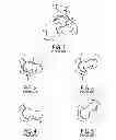 Fig. 02 - Methods and devices for removing abnormalities from bone