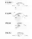 Fig. 08 - OPERATIVE METHOD FOR LUMEN