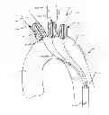 Fig. 01 - Aortic great vessel protection