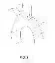 Fig. 02 - Aortic great vessel protection
