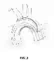 Fig. 04 - Aortic great vessel protection