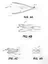 Fig. 05 - Aortic great vessel protection