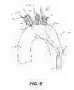 Fig. 07 - Aortic great vessel protection