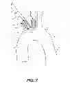 Fig. 08 - Aortic great vessel protection