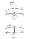 Fig. 09 - Percutaneous hernia repair