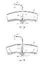 Fig. 13 - Percutaneous hernia repair