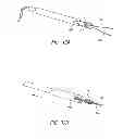 Fig. 15 - Percutaneous hernia repair