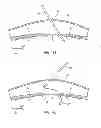 Fig. 16 - Percutaneous hernia repair