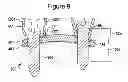 Fig. 12 - Orthopaedic plate