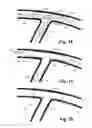 Fig. 09 - Stent system, deployment apparatus and method for bifurcated lesion
