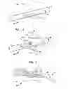 Fig. 02 - Method and device for heart valve repair