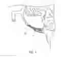 Fig. 02 - Bodily lumen occlusion