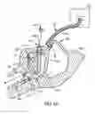 Fig. 08 - DEVICE FOR SURFACTANT ADMINISTRATION AND VENTILATION OF LOW BIRTH WEIGHT INFANTS