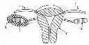 Fig. 01 - Fertility preservation device