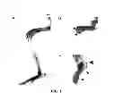 Fig. 02 - METHOD OF TREATING PATHOLOGIC HETEROTOPIC OSSIFICATION