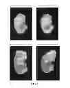 Fig. 07 - METHOD OF TREATING PATHOLOGIC HETEROTOPIC OSSIFICATION