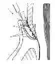 Fig. 01 - PERIODONTAL TREATMENT SYSTEM AND METHOD