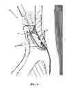 Fig. 09 - PERIODONTAL TREATMENT SYSTEM AND METHOD