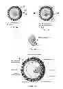 Fig. 02 - Nondestructive means of ectopic pregnancy management