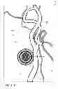 Fig. 16 - Blood vessel sizing device