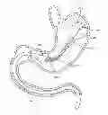 Fig. 01 - INTRAGASTRIC IMPLANT DEVICES