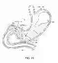 Fig. 02 - INTRAGASTRIC IMPLANT DEVICES