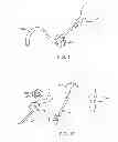 Fig. 04 - INTRAGASTRIC IMPLANT DEVICES