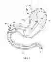Fig. 09 - INTRAGASTRIC IMPLANT DEVICES