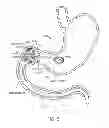 Fig. 10 - INTRAGASTRIC IMPLANT DEVICES