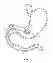 Fig. 12 - INTRAGASTRIC IMPLANT DEVICES