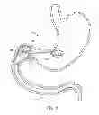 Fig. 13 - INTRAGASTRIC IMPLANT DEVICES